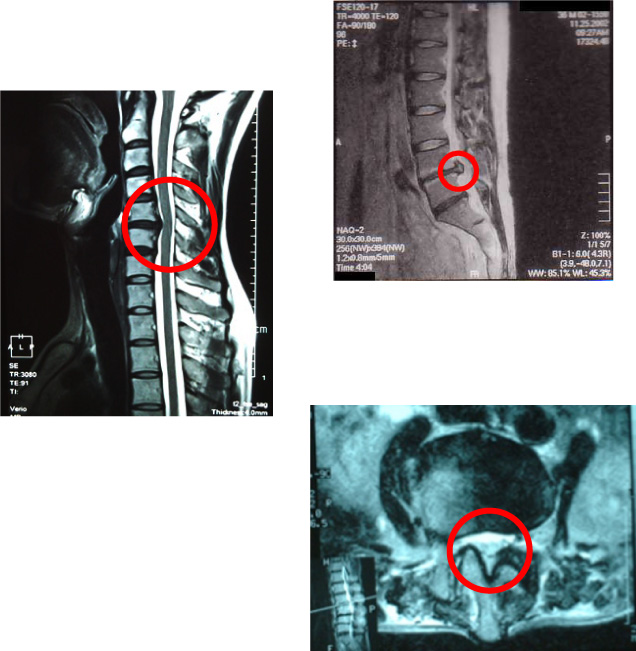 腰椎・頸椎椎間板ヘルニア、腰部脊柱管狭窄症の画像